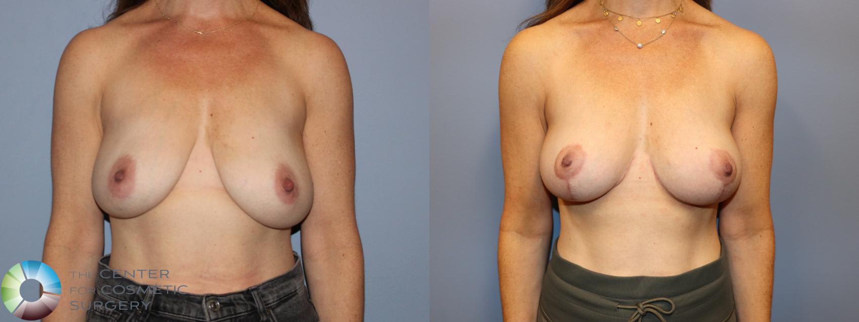 Before & After Breast Reduction Case 12024 Front in Denver and Colorado Springs, CO