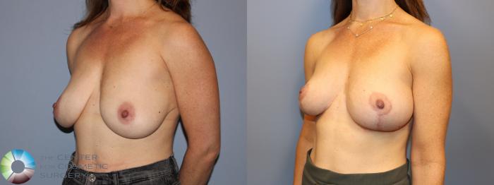 Before & After Breast Reduction Case 12024 Left Oblique in Denver and Colorado Springs, CO