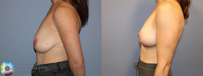 Before & After Breast Lift Case 12024 Left Side in Denver and Colorado Springs, CO