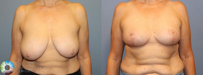 Before & After Breast Reduction Case 12036 Front in Denver and Colorado Springs, CO