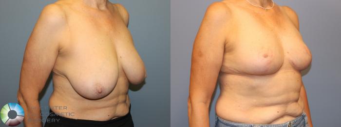 Before & After Breast Reduction Case 12036 Right Oblique in Denver and Colorado Springs, CO