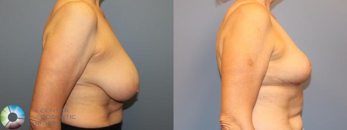 Before & After Breast Reduction Case 12036 Right Side in Denver and Colorado Springs, CO