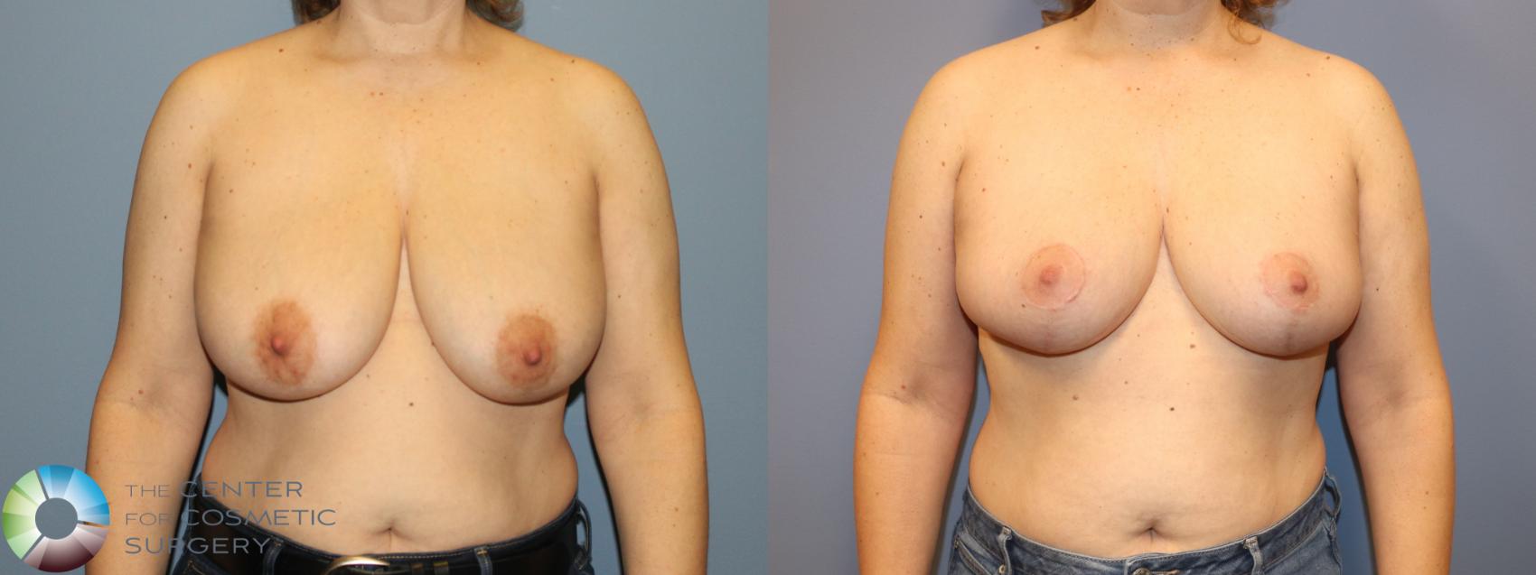 Before & After Breast Reduction Case 12063 Front in Denver and Colorado Springs, CO