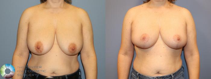 Before & After Breast Reduction Case 12063 Front in Denver and Colorado Springs, CO