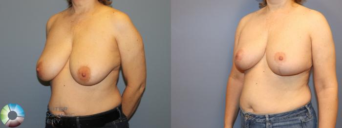 Before & After Breast Reduction Case 12063 Left Oblique in Denver and Colorado Springs, CO