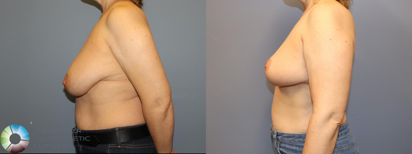 Before & After Breast Reduction Case 12063 Left Side in Denver and Colorado Springs, CO
