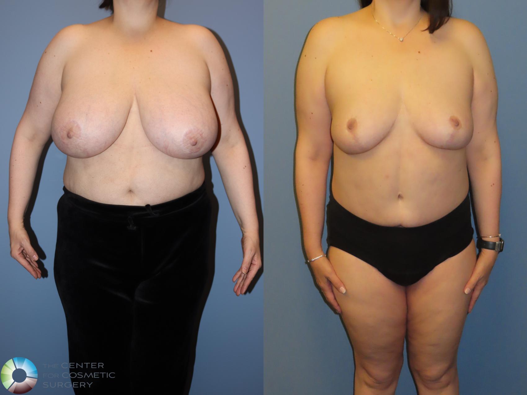 Before & After Breast Reduction Case 12070 Front in Denver and Colorado Springs, CO