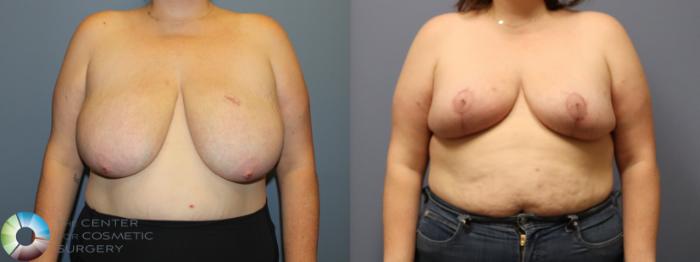 Before & After Breast Reduction Case 12104 Front in Denver and Colorado Springs, CO