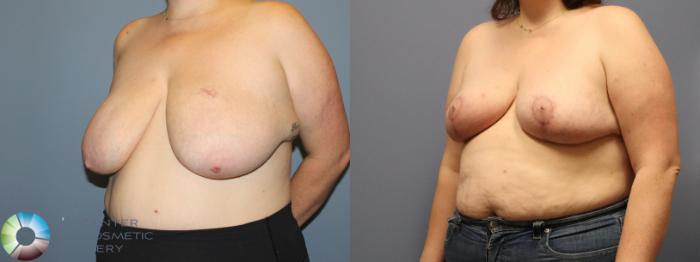 Before & After Breast Reduction Case 12104 Left Oblique in Denver and Colorado Springs, CO