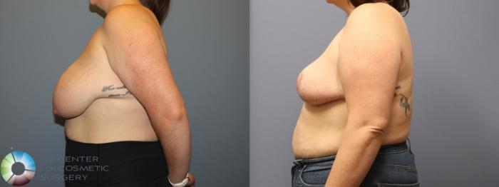 Before & After Breast Reduction Case 12104 Left Side in Denver and Colorado Springs, CO