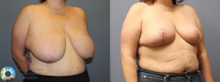 Before & After Breast Reduction Case 12104 Right Oblique in Denver and Colorado Springs, CO