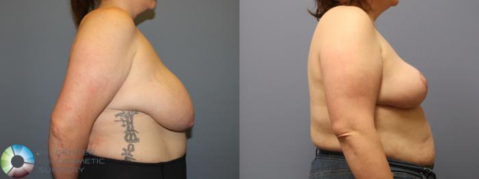 Before & After Breast Reduction Case 12104 Right Side in Denver and Colorado Springs, CO