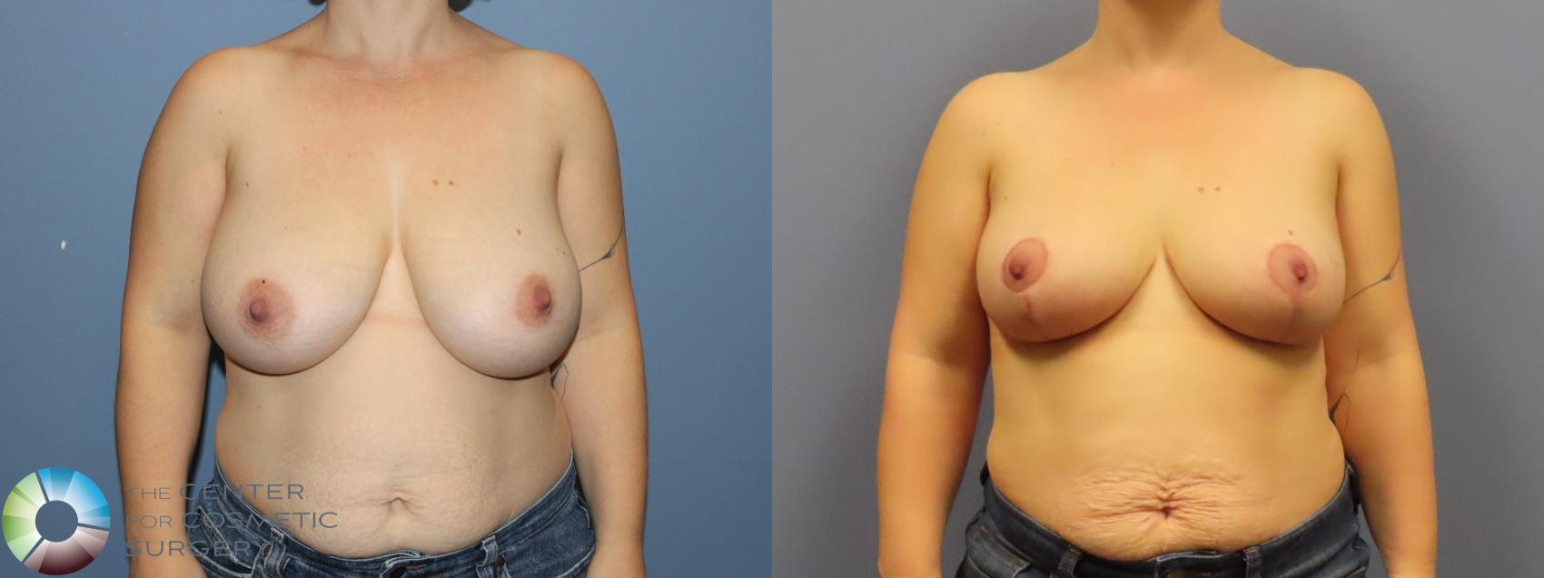 Before & After Breast Reduction Case 12110 Front in Denver and Colorado Springs, CO