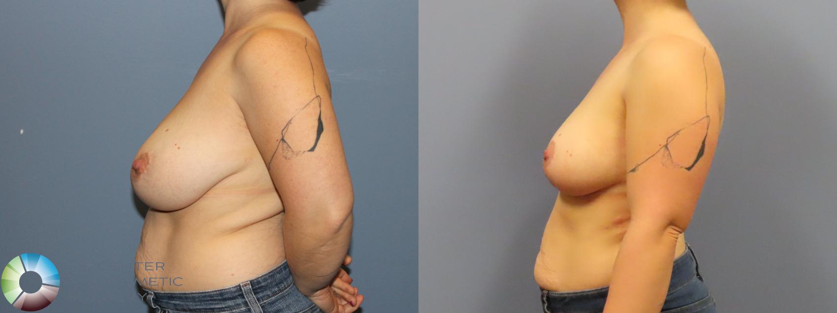 Before & After Breast Reduction Case 12110 Left Side in Denver and Colorado Springs, CO