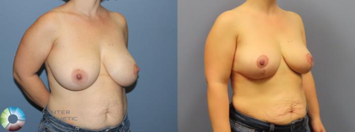 Before & After Breast Reduction Case 12110 Right Oblique in Denver and Colorado Springs, CO