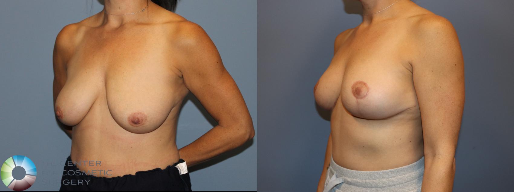 Before & After Breast Reduction Case 12119 Left Oblique in Denver and Colorado Springs, CO