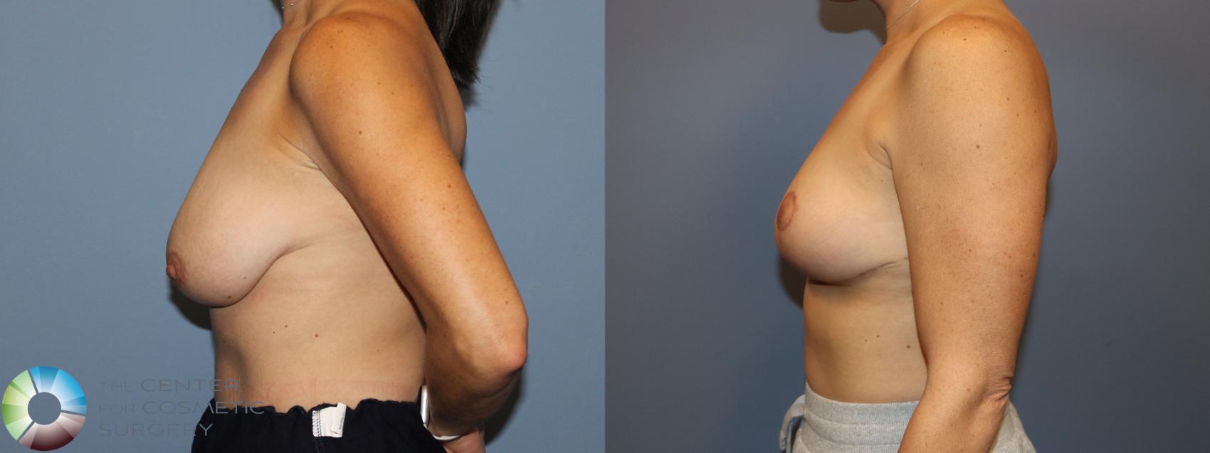 Before & After Breast Reduction Case 12119 Left Side in Denver and Colorado Springs, CO