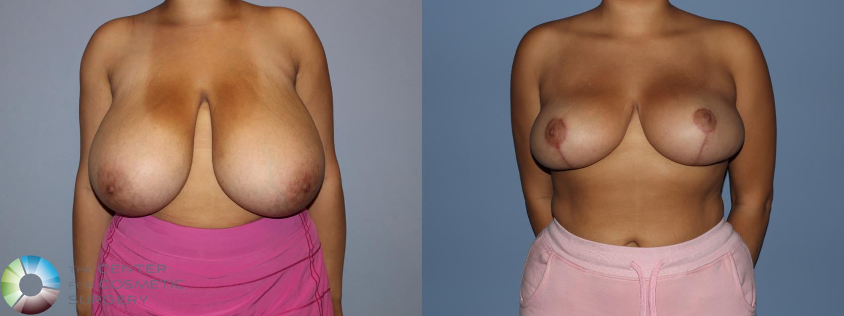 Before & After Breast Reduction Case 12188 Front in Denver and Colorado Springs, CO