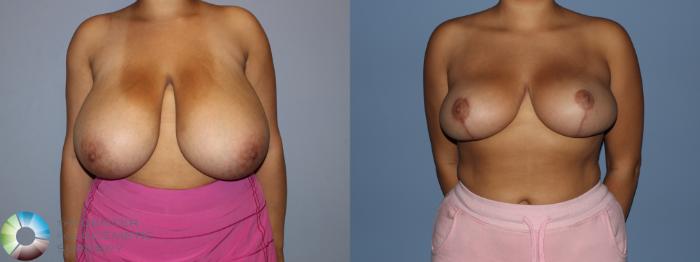 Before & After Breast Reduction Case 12188 Front in Denver and Colorado Springs, CO