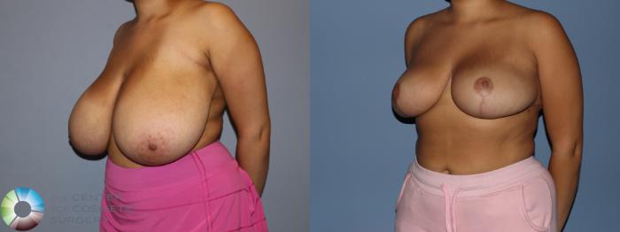 Before & After Breast Reduction Case 12188 Left Oblique in Denver and Colorado Springs, CO