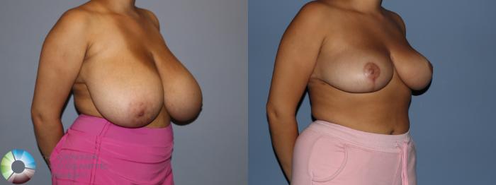 Before & After Breast Reduction Case 12188 Right Oblique in Denver and Colorado Springs, CO