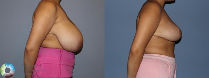Before & After Breast Reduction Case 12188 Right Side in Denver and Colorado Springs, CO