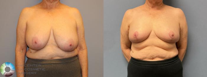 Before & After Breast Reduction Case 12222 Front in Denver and Colorado Springs, CO