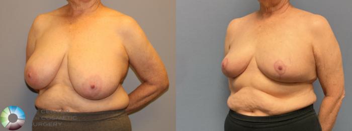 Before & After Breast Reduction Case 12222 Left Oblique in Denver and Colorado Springs, CO