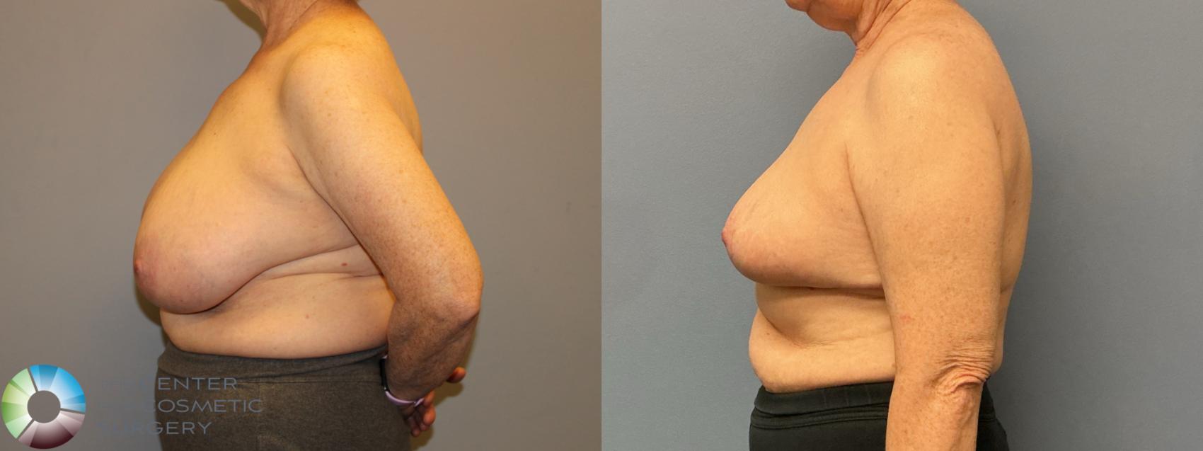 Before & After Breast Reduction Case 12222 Left Side in Denver and Colorado Springs, CO