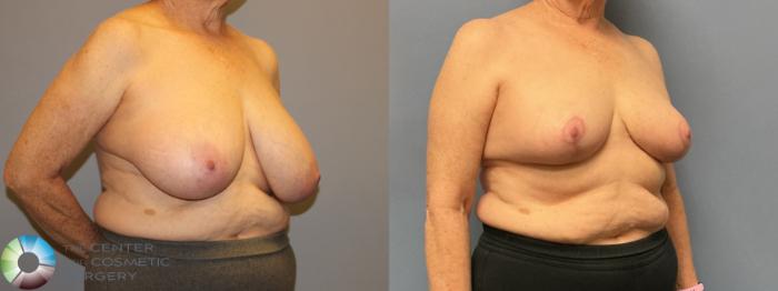 Before & After Breast Reduction Case 12222 Right Oblique in Denver and Colorado Springs, CO