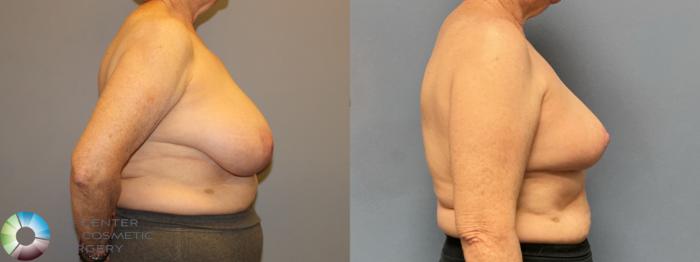 Before & After Breast Reduction Case 12222 Right Side in Denver and Colorado Springs, CO