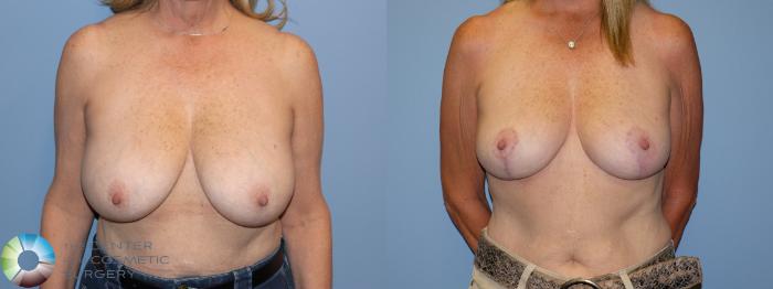 Before & After Breast Reduction Case 12224 Front in Denver and Colorado Springs, CO