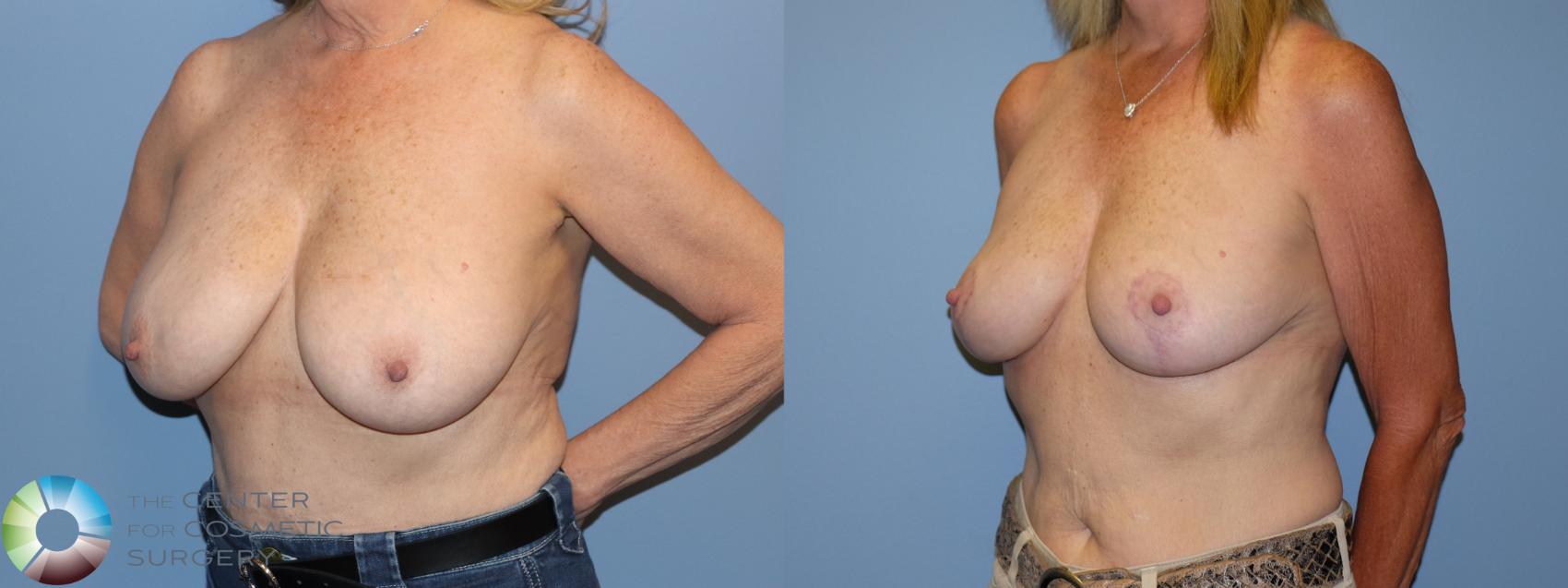 Before & After Breast Reduction Case 12224 Left Oblique in Denver and Colorado Springs, CO