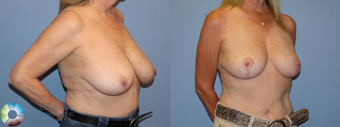 Before & After Breast Reduction Case 12224 Right Oblique in Denver and Colorado Springs, CO