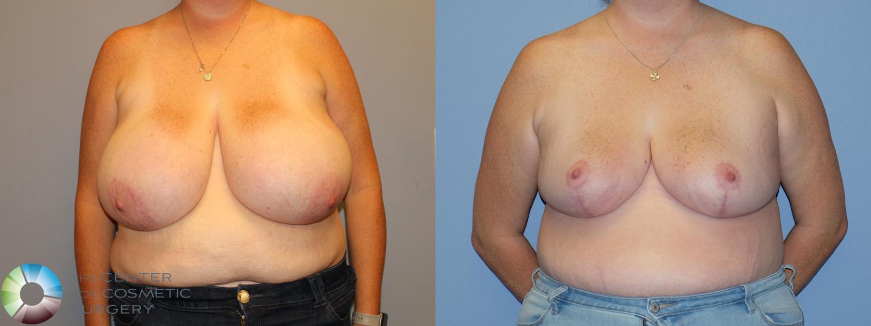 Before & After Breast Reduction Case 12225 Front in Denver and Colorado Springs, CO