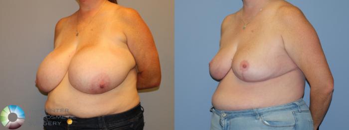 Before & After Breast Reduction Case 12225 Left Oblique in Denver and Colorado Springs, CO