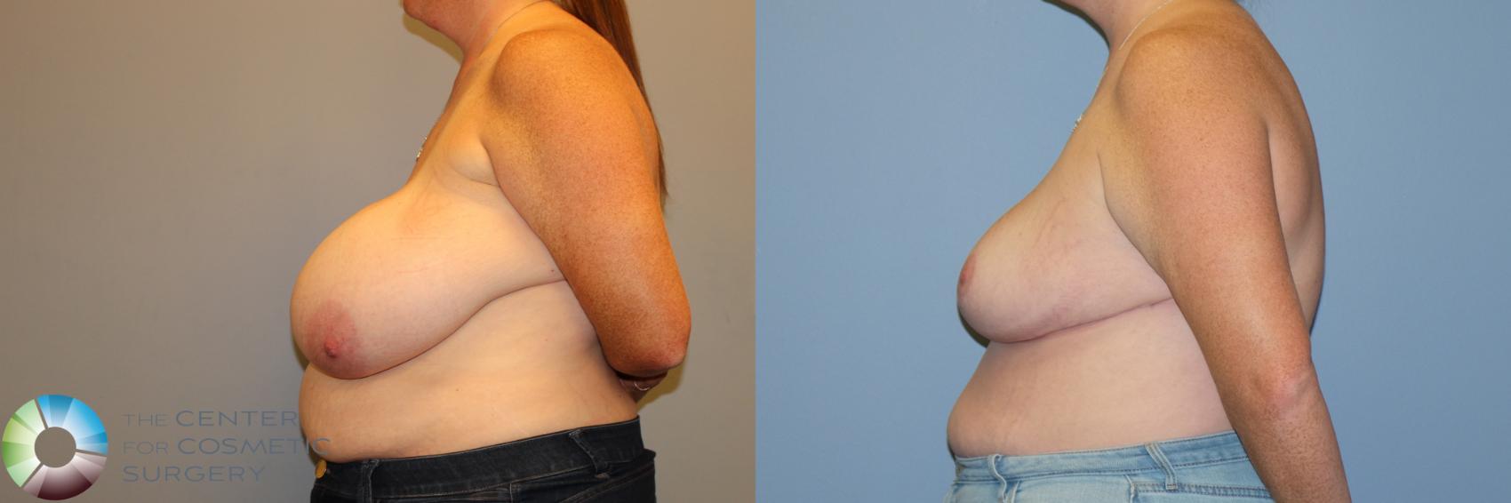 Before & After Breast Reduction Case 12225 Left Side in Denver and Colorado Springs, CO