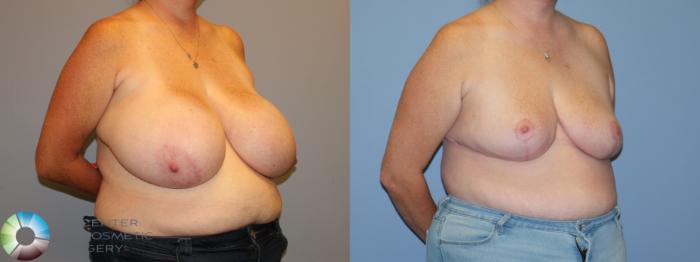 Before & After Breast Reduction Case 12225 Right Oblique in Denver and Colorado Springs, CO