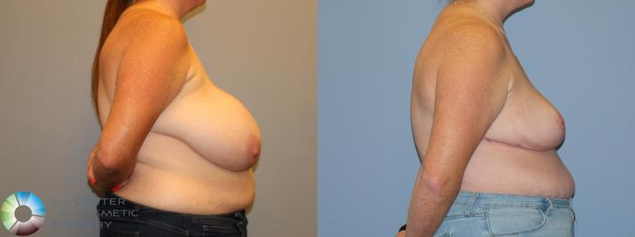 Before & After Breast Reduction Case 12225 Right Side in Denver and Colorado Springs, CO
