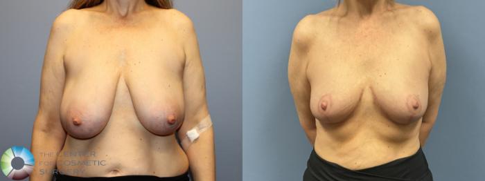 Before & After Breast Reduction Case 12230 Front in Denver and Colorado Springs, CO