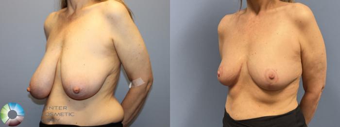 Before & After Breast Reduction Case 12230 Left Oblique in Denver and Colorado Springs, CO