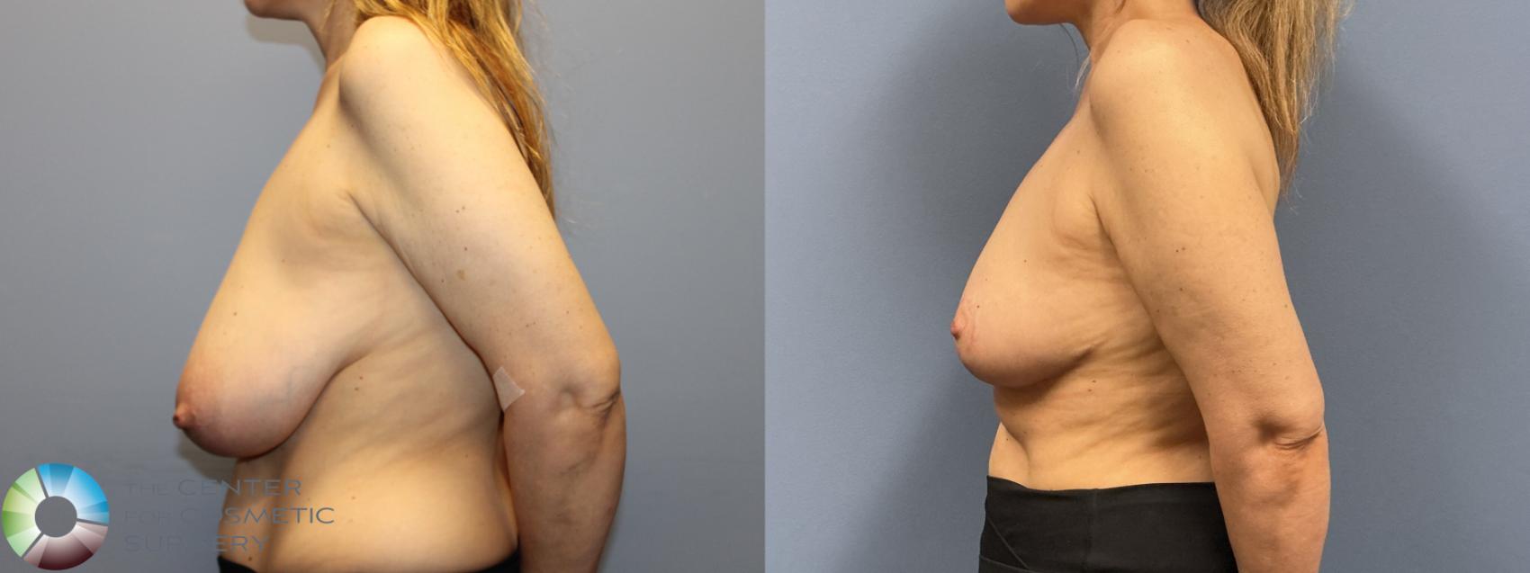 Before & After Breast Reduction Case 12230 Left Side in Denver and Colorado Springs, CO
