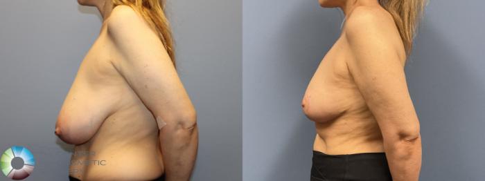 Before & After Breast Reduction Case 12230 Left Side in Denver and Colorado Springs, CO
