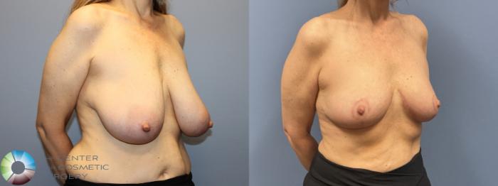 Before & After Breast Reduction Case 12230 Right Oblique in Denver and Colorado Springs, CO