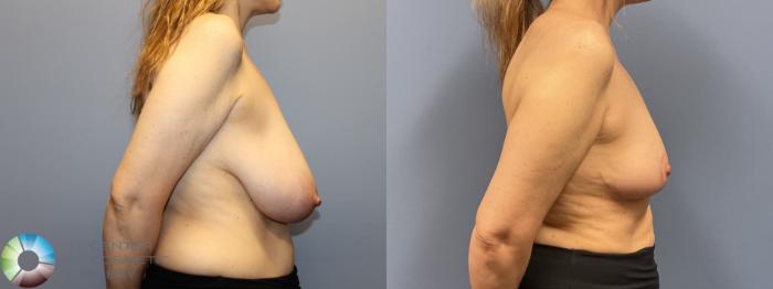 Before & After Breast Reduction Case 12230 Right Side in Denver and Colorado Springs, CO
