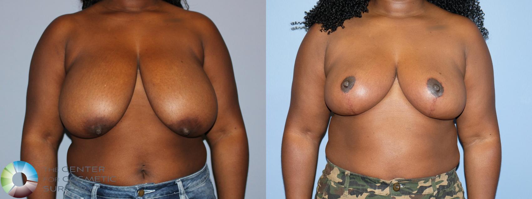 Before & After Breast Reduction Case 12231 Front in Denver and Colorado Springs, CO