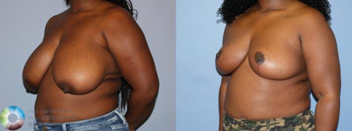 Before & After Breast Reduction Case 12231 Left Oblique in Denver and Colorado Springs, CO