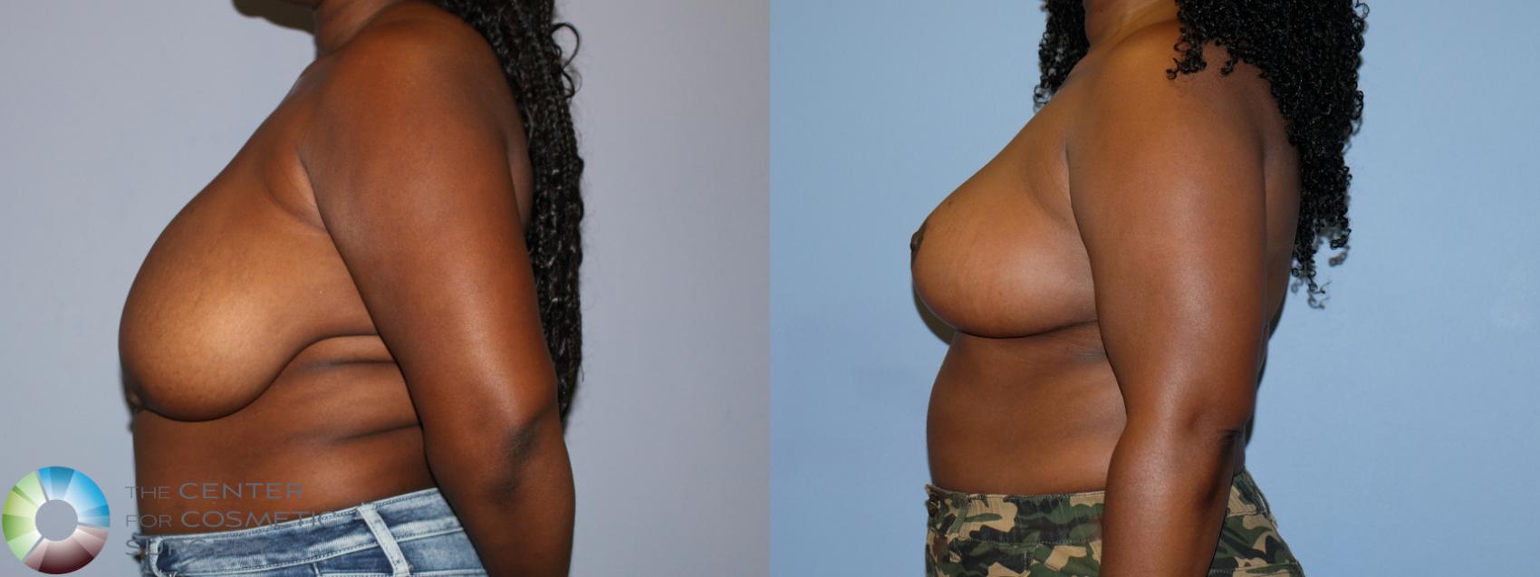 Before & After Breast Reduction Case 12231 Left Side in Denver and Colorado Springs, CO