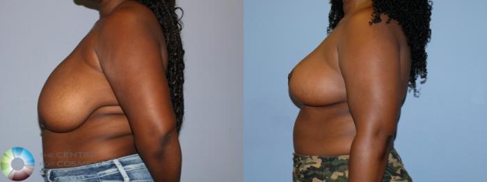 Before & After Breast Reduction Case 12231 Left Side in Denver and Colorado Springs, CO