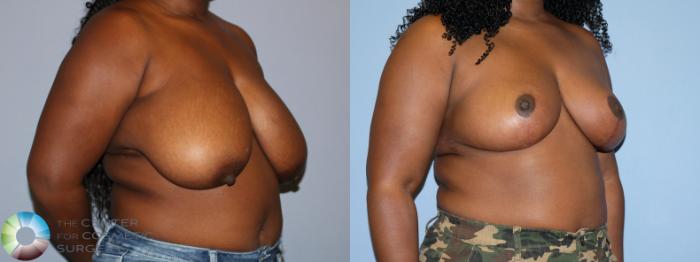 Before & After Breast Reduction Case 12231 Right Oblique in Denver and Colorado Springs, CO
